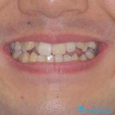 左右の八重歯が気になる　ワイヤー装置での咬み合わせ改善の治療前（顔貌）