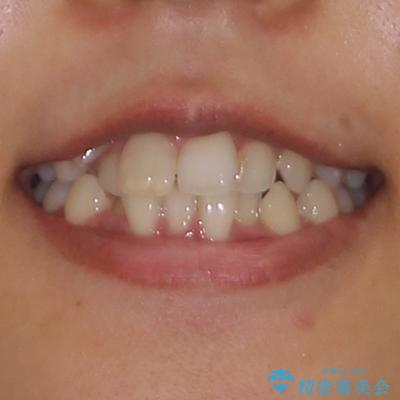 気になる八重歯 目立ちにくいハーフリンガルでの抜歯矯正の治療前(顔貌)