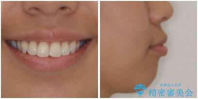 抜歯矯正で唇を閉じやすく 目立たないワイヤー装置の治療前(顔貌)