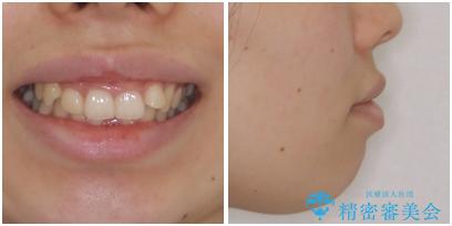 下顎前歯が隠れて突出した口元 ワイヤー装置での抜歯矯正の治療前(顔貌)