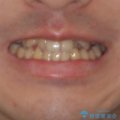 八重歯とクロスバイト　目立たないワイヤー装置で矯正治療の治療前（顔貌）