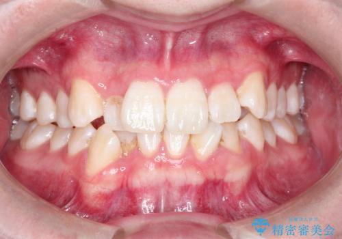 【インビザライン】前歯のガタガタ。非抜歯治療の治療前