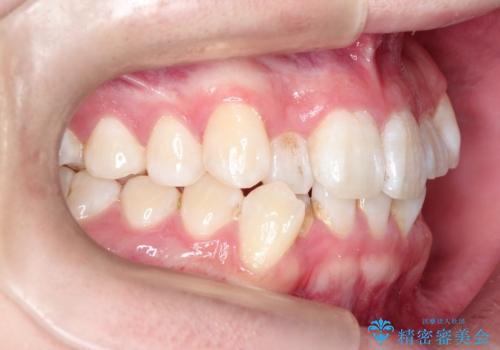 【インビザライン】前歯のガタガタ。非抜歯治療の治療前