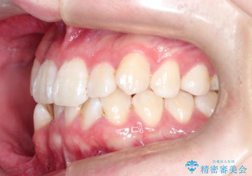 【インビザライン】前歯のガタガタ。非抜歯治療の治療前