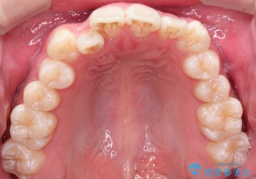 【インビザライン】前歯のガタガタ。非抜歯治療の治療前
