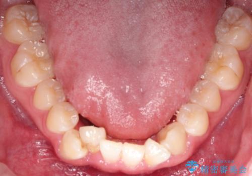 【インビザライン】前歯のガタガタ。非抜歯治療の治療前