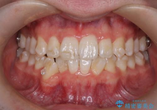 【インビザライン】前歯のガタガタ。非抜歯治療の治療中