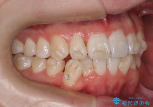 【インビザライン】前歯のガタガタ。非抜歯治療の治療中