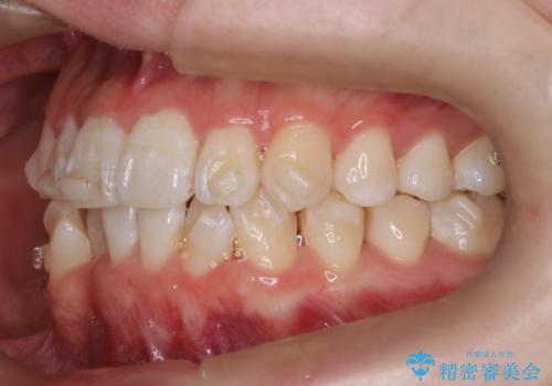 【インビザライン】前歯のガタガタ。非抜歯治療の治療中