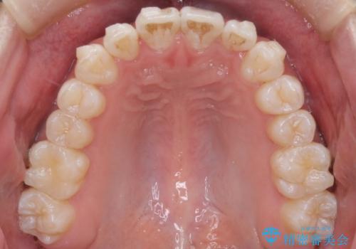 【インビザライン】前歯のガタガタ。非抜歯治療の治療中