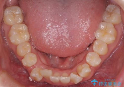 【インビザライン】前歯のガタガタ。非抜歯治療の治療中