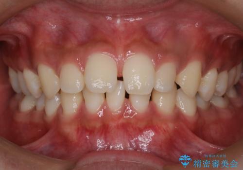 【インビザライン】空隙歯列の矯正の治療前