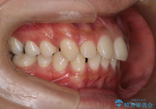 【インビザライン】空隙歯列の矯正の治療前