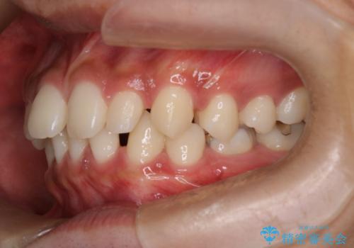 【インビザライン】空隙歯列の矯正の治療前