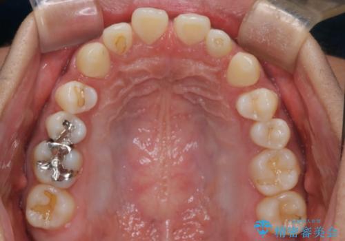 【インビザライン】空隙歯列の矯正の治療前