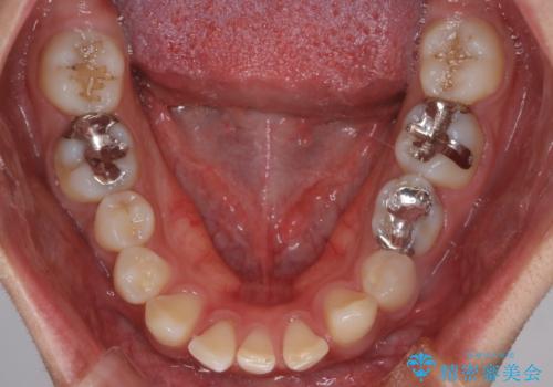 【インビザライン】空隙歯列の矯正の治療前