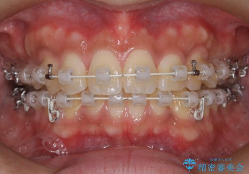 【審美ワイヤー】奥歯のガタガタを治したいの治療中