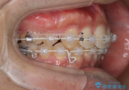 【審美ワイヤー】奥歯のガタガタを治したいの治療中