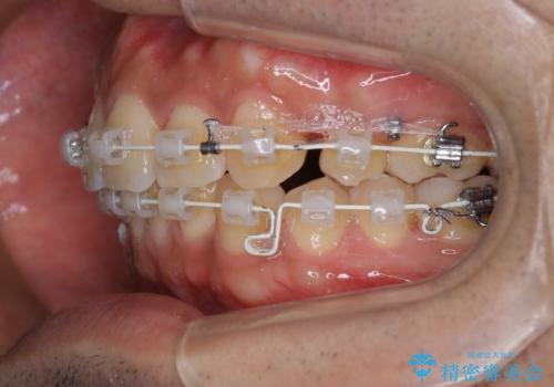 【審美ワイヤー】奥歯のガタガタを治したいの治療中