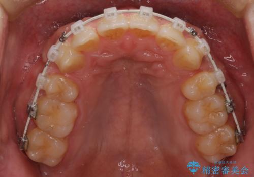 【審美ワイヤー】奥歯のガタガタを治したいの治療中