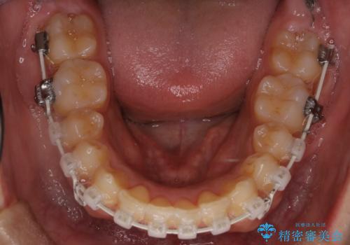 【審美ワイヤー】奥歯のガタガタを治したいの治療中