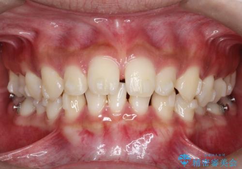 【インビザライン】空隙歯列の矯正の治療中