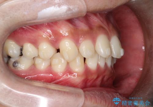 【インビザライン】空隙歯列の矯正の治療中