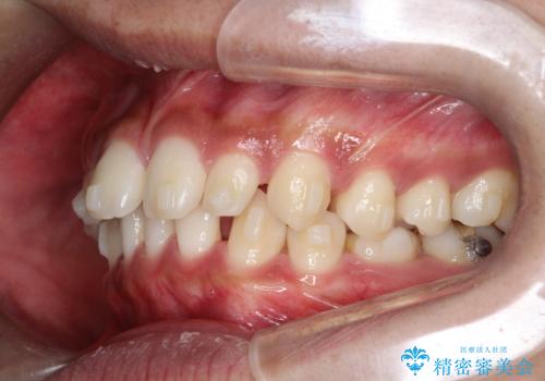 【インビザライン】空隙歯列の矯正の治療中