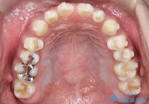 【インビザライン】空隙歯列の矯正の治療中
