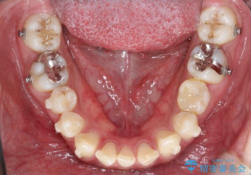 【インビザライン】空隙歯列の矯正の治療中