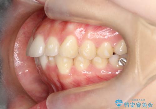 【インビザライン】前歯を下げたいの治療中