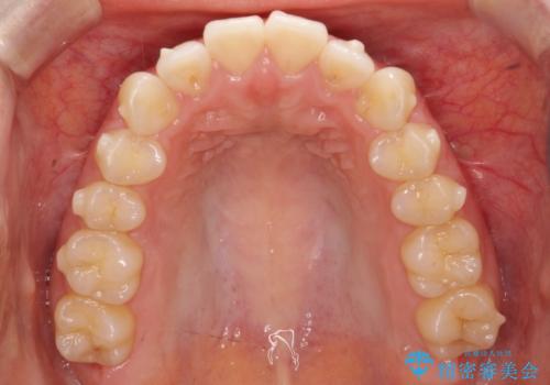 【インビザライン】前歯を下げたいの治療中
