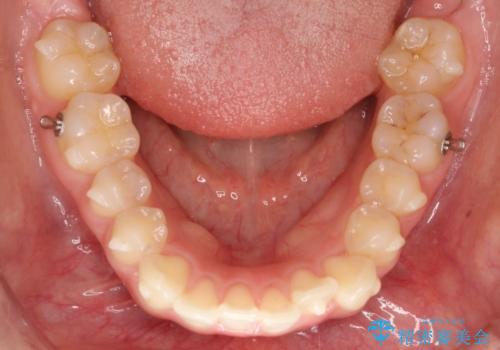 【インビザライン】前歯を下げたいの治療中