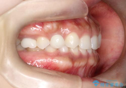 【総合歯科治療】インプラント+インビザラインの治療後