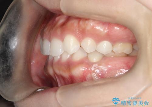 【総合歯科治療】インプラント+インビザラインの治療後