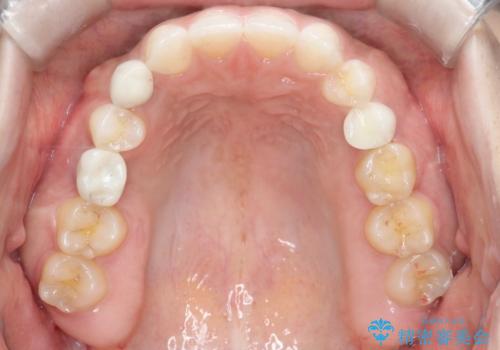 【総合歯科治療】インプラント+インビザラインの治療後