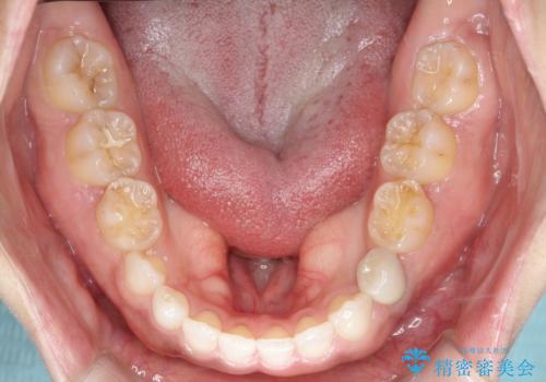 【総合歯科治療】インプラント+インビザラインの治療後