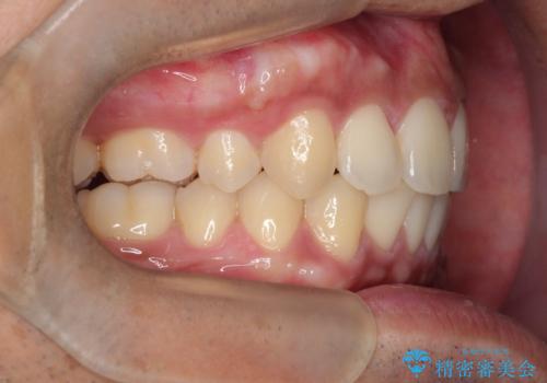 【審美ワイヤー】奥歯のガタガタを治したいの治療後