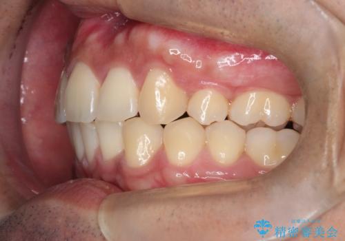 【審美ワイヤー】奥歯のガタガタを治したいの治療後