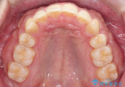 【審美ワイヤー】奥歯のガタガタを治したいの治療後