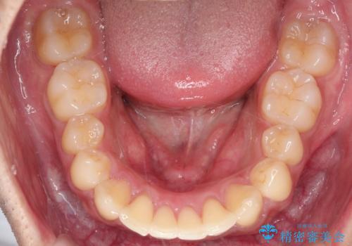 【審美ワイヤー】奥歯のガタガタを治したいの治療後