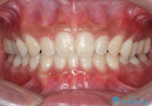 【インビザライン】空隙歯列の矯正の治療後