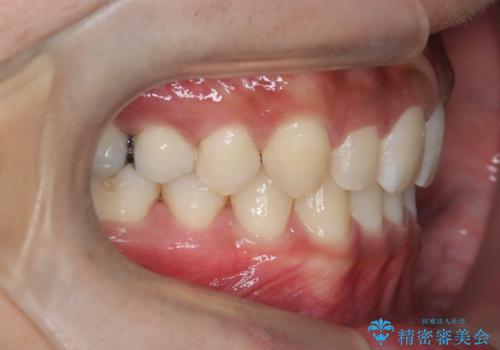 【インビザライン】空隙歯列の矯正の治療後