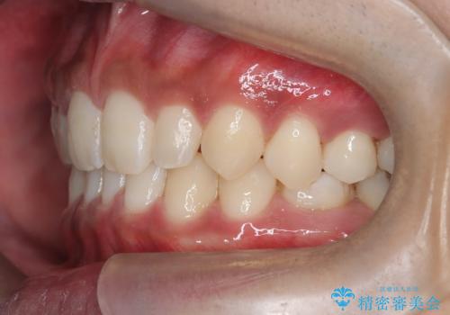【インビザライン】空隙歯列の矯正の治療後
