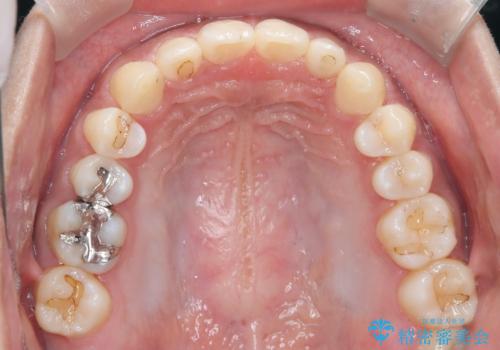 【インビザライン】空隙歯列の矯正の治療後