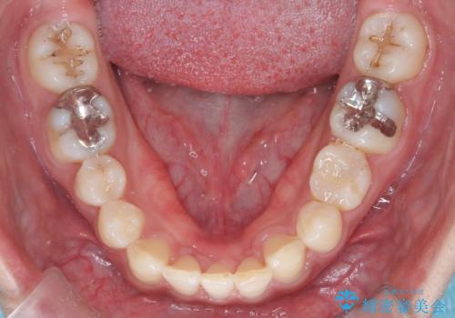 【インビザライン】空隙歯列の矯正の治療後