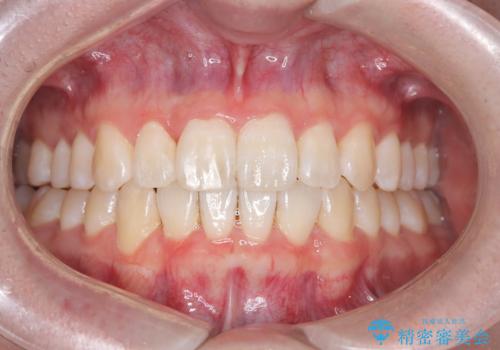 【インビザライン】前歯のガタガタ。非抜歯治療
