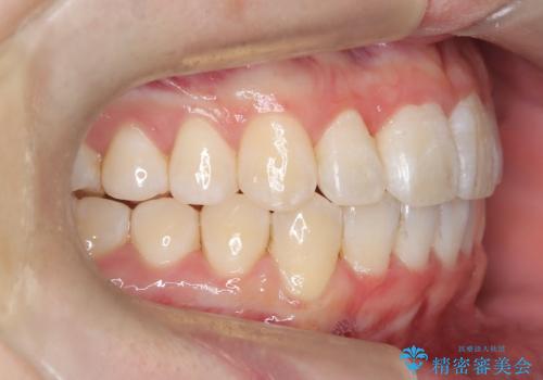 【インビザライン】前歯のガタガタ。非抜歯治療の治療後
