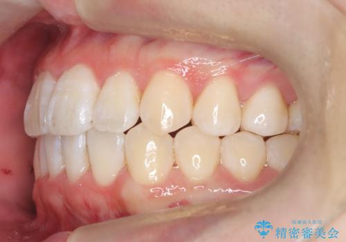 【インビザライン】前歯のガタガタ。非抜歯治療の治療後