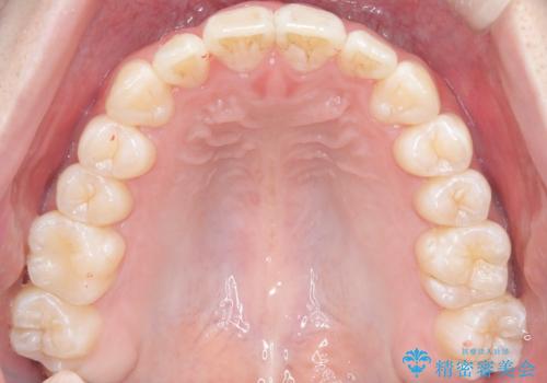 【インビザライン】前歯のガタガタ。非抜歯治療の治療後